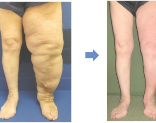 婦人科医の先生から見たリンパ浮腫｜紹介医向けホームページ むくみ 